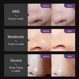 Deep Cleaning Blackhead Remover-50g