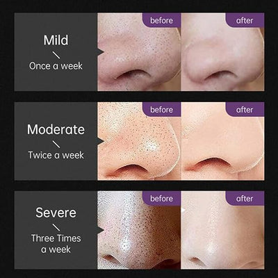 Deep Cleaning Blackhead Remover-50g